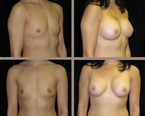 Breast Surgery | Plastic Surgery of Southern New England | Fall River, MA