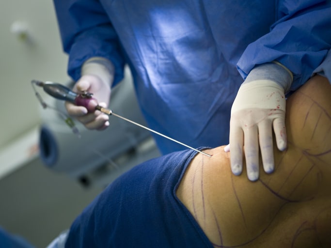 Liposuction Procedure A surgeon performing a Liposuction Procedure on a womans midsection.