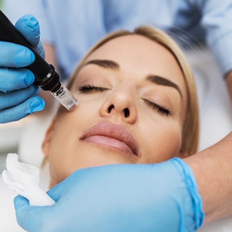 Microneedling-with-PRP-1